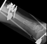 Open tibial fracture