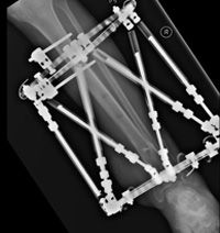 Tibial reconstruction