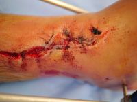 Open tibial fracture
