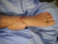 Free flap reconstruction. Open tibial fracture