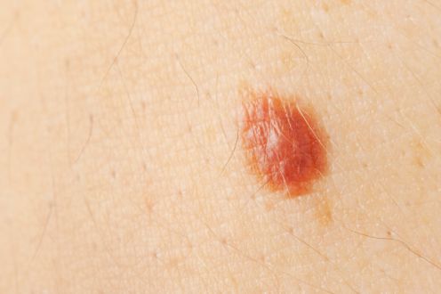 Skin cancer and reconstruction