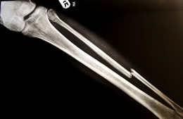 Lower limb trauma Lower limb reconstruction